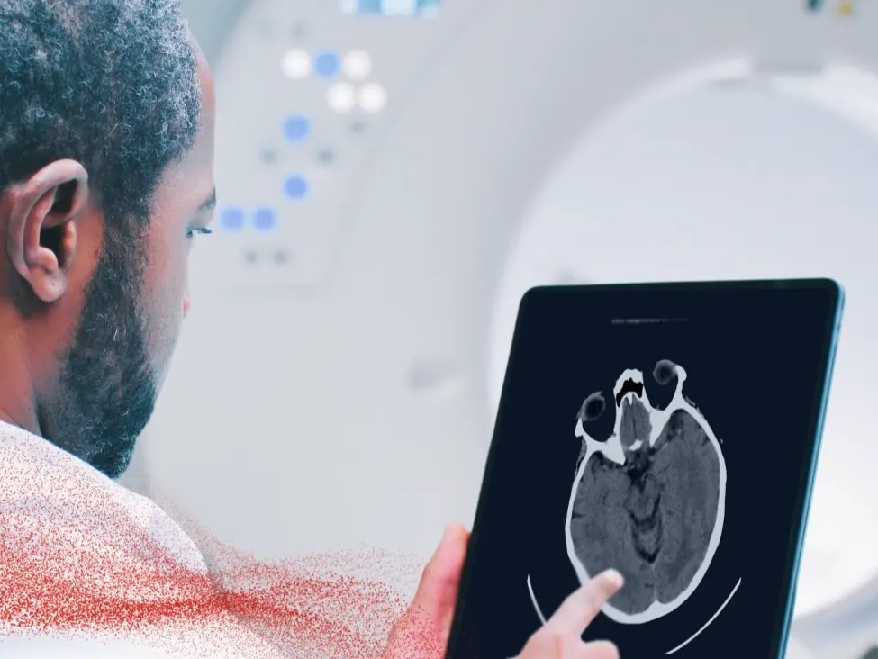 Ictus acuto e IA: la nuova frontiera diagnostica della Asl di Teramo