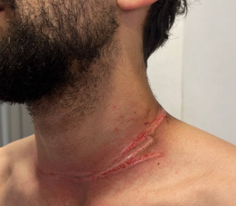 Cavo teso sulla carreggiata: motociclista ferito al collo